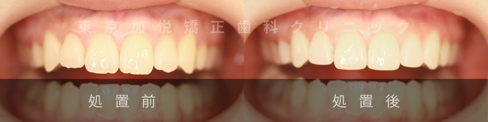 歯の形態修正の症例写真