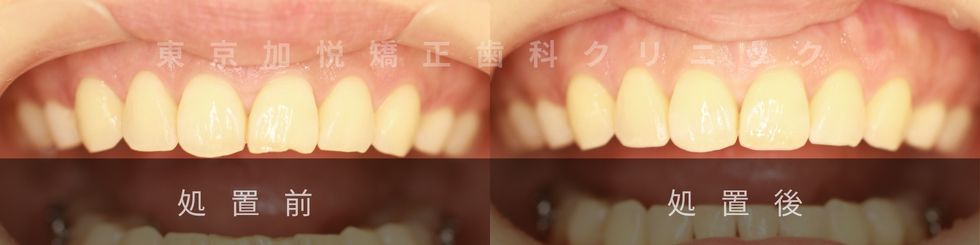 歯の形態修正の症例写真