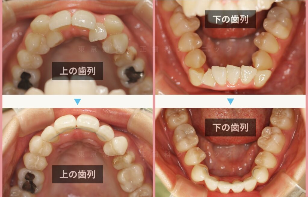 咬合面の治療前後写真