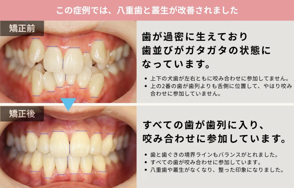 上下前歯を矯正して、叢生・八重歯を改善した症例の解説画像